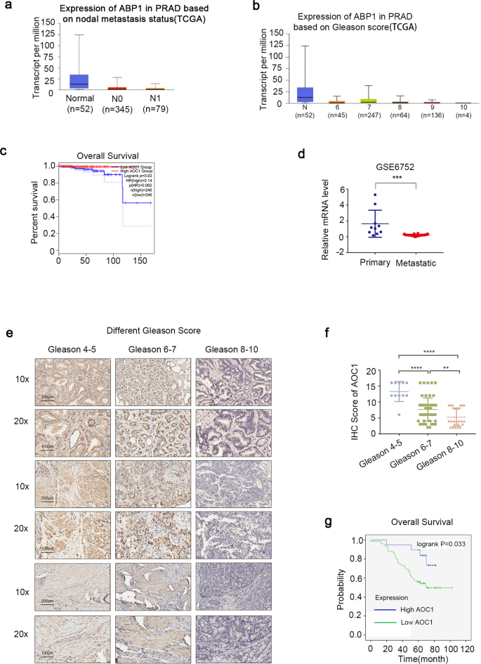 Fig. 2: Expression of AOC1 is correlated with clinical outcomes of prostate cancer.