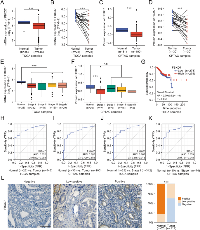 Fig. 1: FBXO7 mRNA and FBXO7 protein expression level are downregulated in ECa patients.