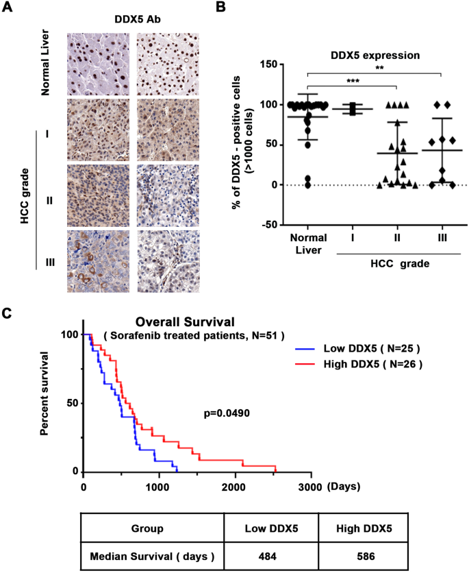 肝臓がん治療の新たなアプローチを示す発見(Discovery points to new approach to treating liver cancer)