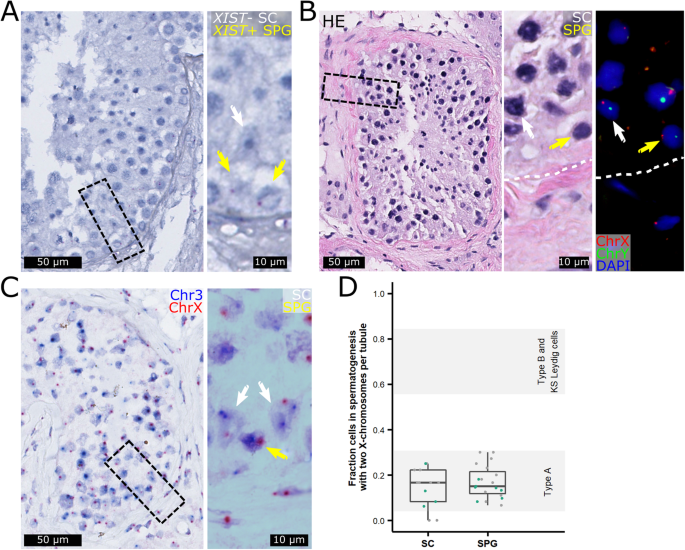 Fig. 2: XIST is expressed in spermatogonia but is absent in Sertoli cells supporting focal spermatogenesis, and both cells are euploid.