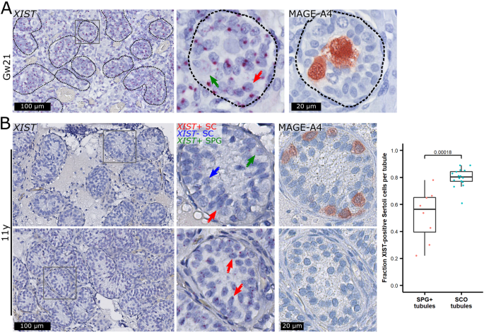 Fig. 3: High XIST expression in Sertoli cells in fetuses but low XIST expression in tubules with spermatogonia compared to Sertoli cell-only (SCO) tubules in an 11-year-old prepubertal boy.