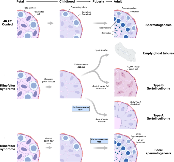 Fig. 4: Schematic illustration of germ cell loss and the proposed model of X-chromosome loss in specific cell stages in the testes from men with Klinefelter syndrome (KS).