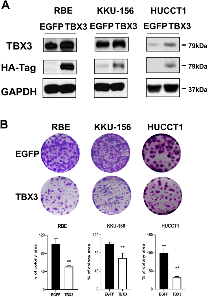 Fig. 1: Overexpression of TBX3 impedes the growth of human intrahepatic cholangiocarcinoma in vitro.