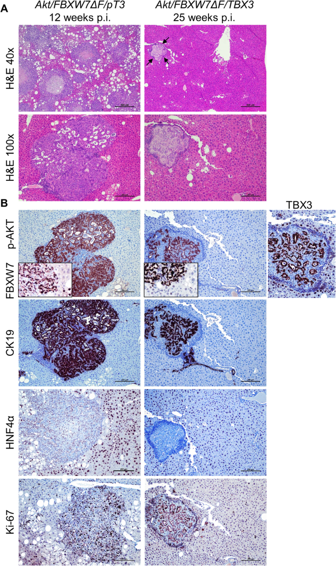 Fig. 3: Overexpression of TBX3 delays Akt/FBXW7ΔF-driven cholangiocarcinogenesis.