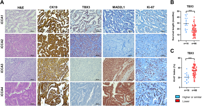 Fig. 8: Representative immunohistochemical patterns of TBX3 and MAD2L1 proteins in human intrahepatic cholangiocarcinoma specimens (iCCA; n = 82).