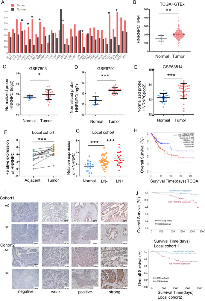 Fig. 1: HNRNPC overexpression in cervical cancer: clinical and prognostic implications.