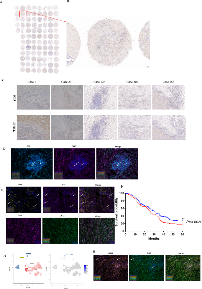 Fig. 3: Association of high TIGIT expression with reduced survival in ECCA patients.