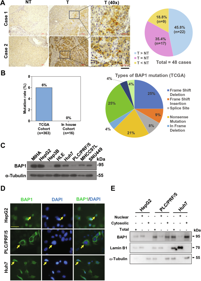 Fig. 2: Cytoplasmic BAP1 was upregulated in human HCCs.