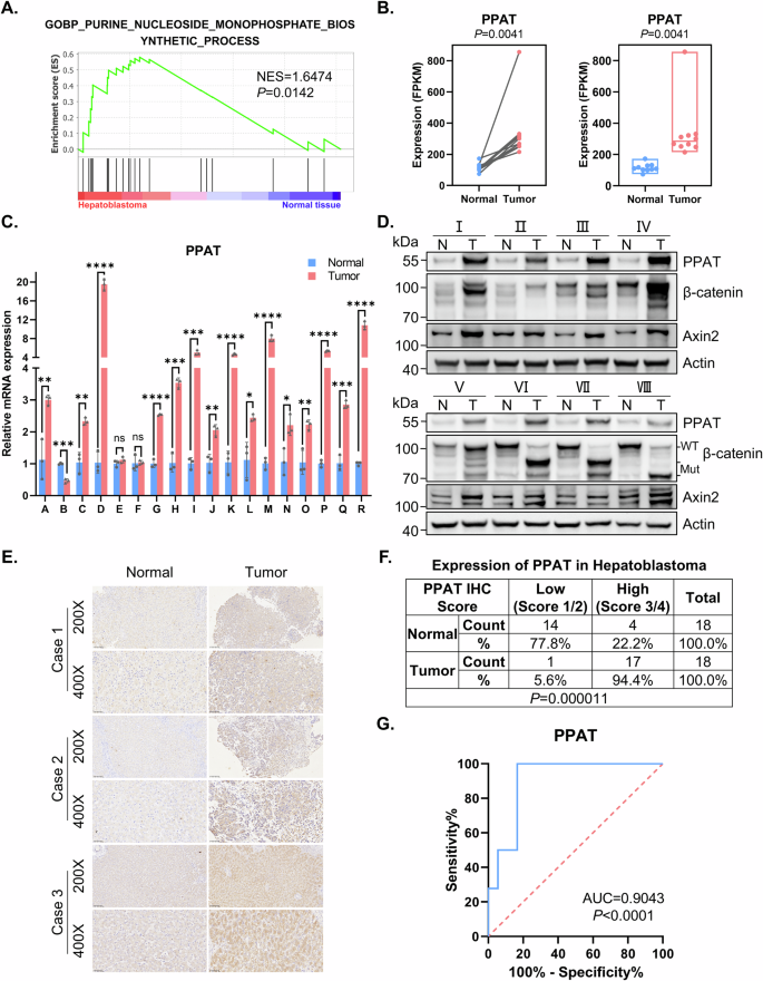 Therapeutic targeting de novo purine biosynthesis driven by β-catenin-dependent PPAT upregulation in hepatoblastoma Therapeutic targeting de novo purine biosynthesis driven by β-catenin-dependent PPAT upregulation in hepatoblastoma