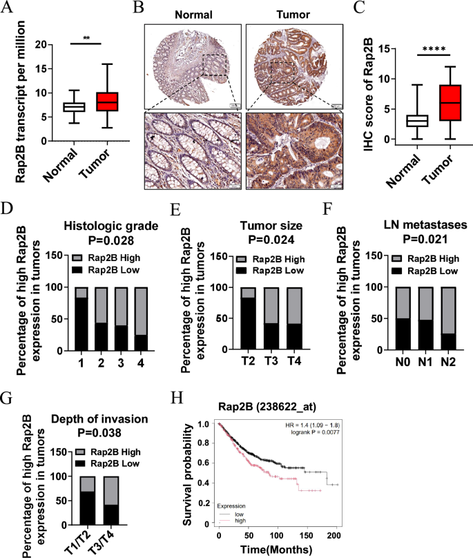 Fig. 1: Rap2B positively correlates with increased metastasis and poor prognosis in CRC patients.