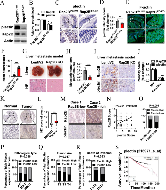 Fig. 8: Plectin positively correlates with Rap2B and predicts malignant progression of CRC.