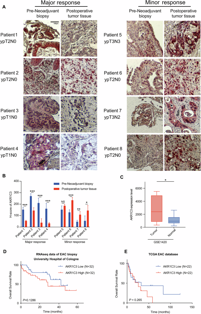 Fig. 2: AKR1C3 affects therapeutic response and prognosis of EAC patients.