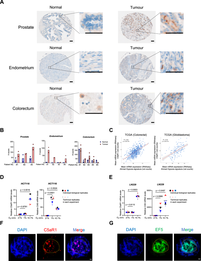 Fig. 1: C5aR1 is highly expressed in hypoxic tumour regions.