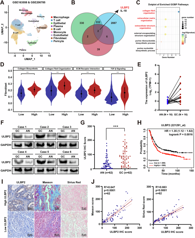 Fig. 1: ULBP2 is overexpressed in GC and correlated with collagen deposition.