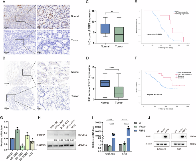 Fig. 2: The expression and clinical significance of FBP2 in GC tissues, as well as the establishment and validation of FBP2 overexpression in GC cell lines.