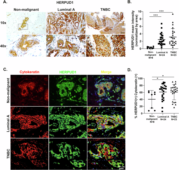 Fig. 1: HERPUD1 levels are increased in breast biopsies from breast cancer patients and are positively associated with immune infiltration in TNBC.