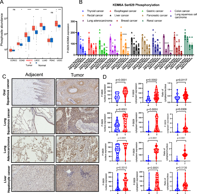 Fig. 1: KDM6A-pSer829 levels are aberrantly high in HNSCC.