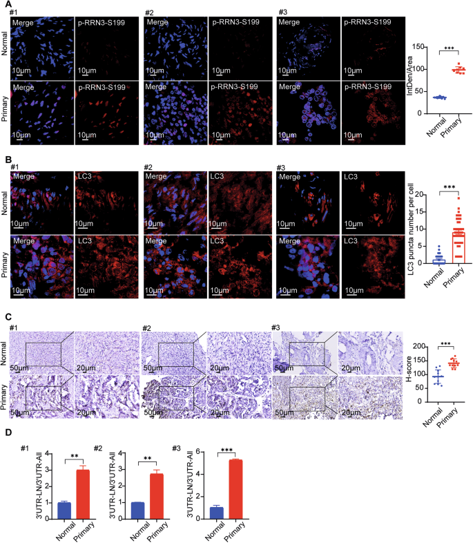 Fig. 8: Phosphorylation of RRN3 at serine 199 enhances autophagy contributing to ovarian cancer progression.