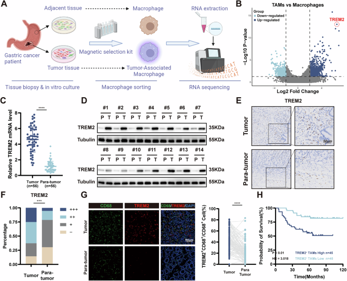 Fig. 1: TREM2 is overexpressed in TAMs and is related to poor prognosis in GC patients.