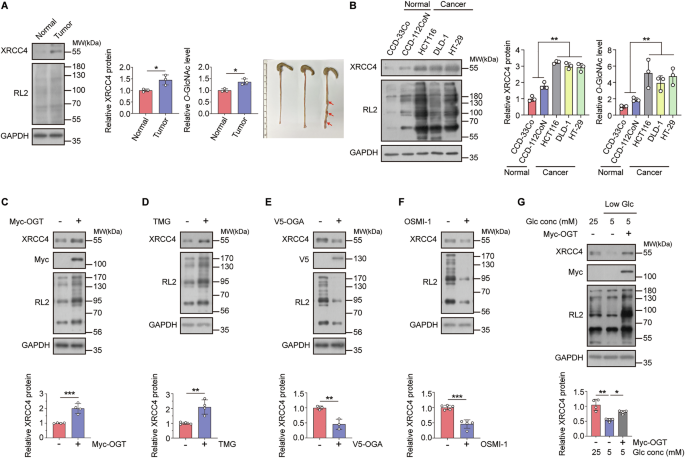Fig. 1: XRCC4 protein levels are regulated by cellular O-GlcNAcylation levels in colon cancer tissues and cell lines.