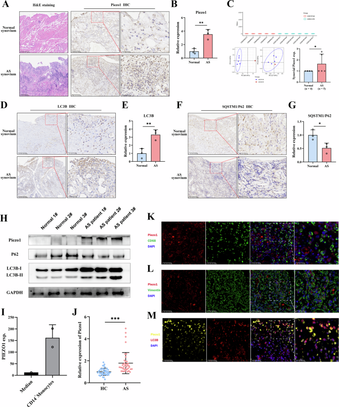 Fig. 2: Expression of Piezo1 and autophagy-related proteins in AS patients.