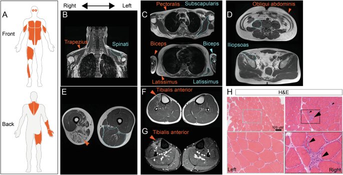 Fig. 1: Clinical presentation, muscle imaging and histopathology.