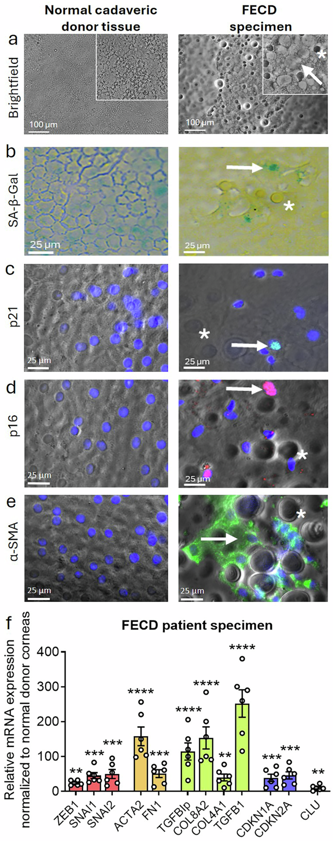 Fig. 1: Senescence and fibrosis in Fuchs endothelial corneal dystrophy (FECD) patient specimens.