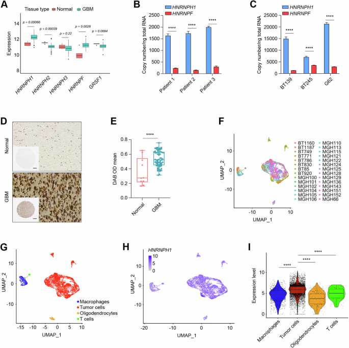 Fig. 1: HNRNPH1 is overexpressed in GBM.
