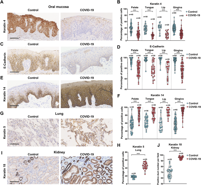 Fig. 1: Epithelial cell dedifferentiation in the COVID-19 patient oral mucosa, lung and kidney epithelium.