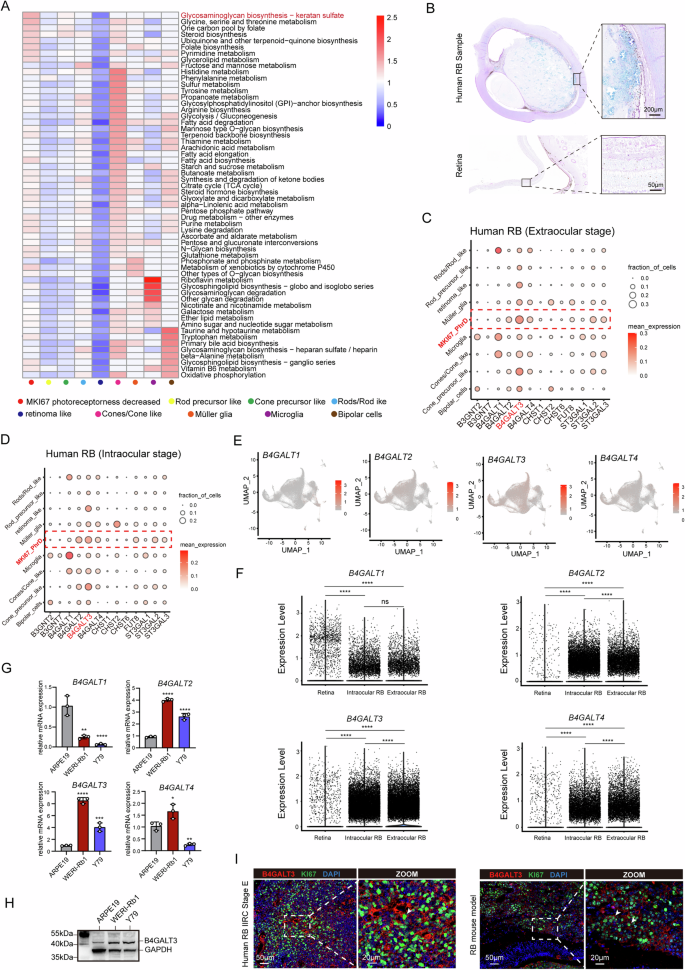 Fig. 1: Increased expression of B4GALT3 in retinoblastoma.