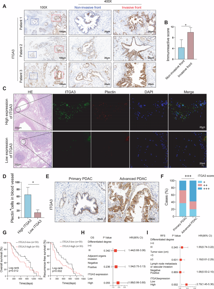 Fig. 2: Clinical significance of ITGA3 expression in relation to CTCs formation, tumor invasion, and prognosis in PDAC patients.