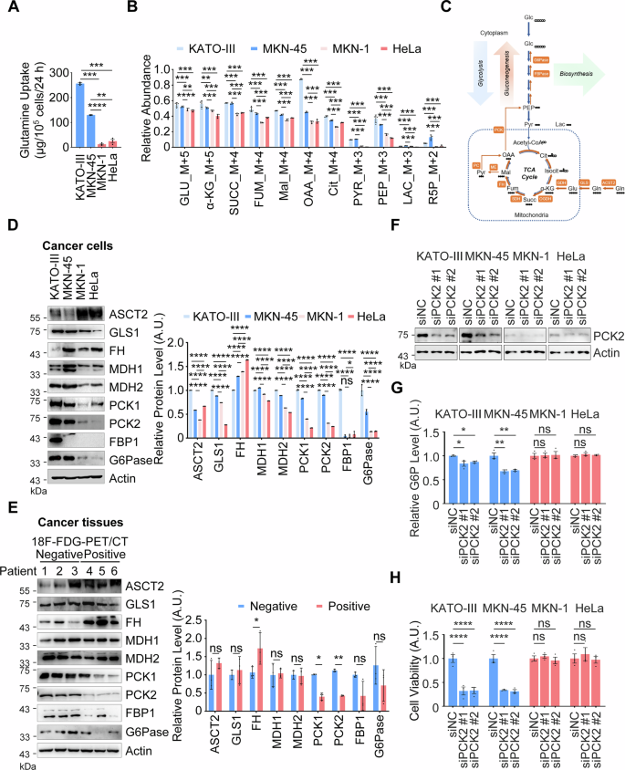 Fig. 2: Glutamine-based gluconeogenesis back up macromolecule synthesis in 18F-FDG-PET/CT-negative gastric cancer.
