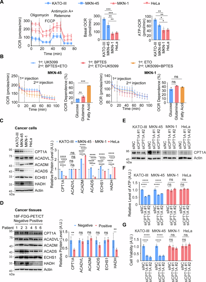 Fig. 3: The expression of PCK2 or CPT1A negatively associate with 18F-FDG-PET/CT in gastric cancer.