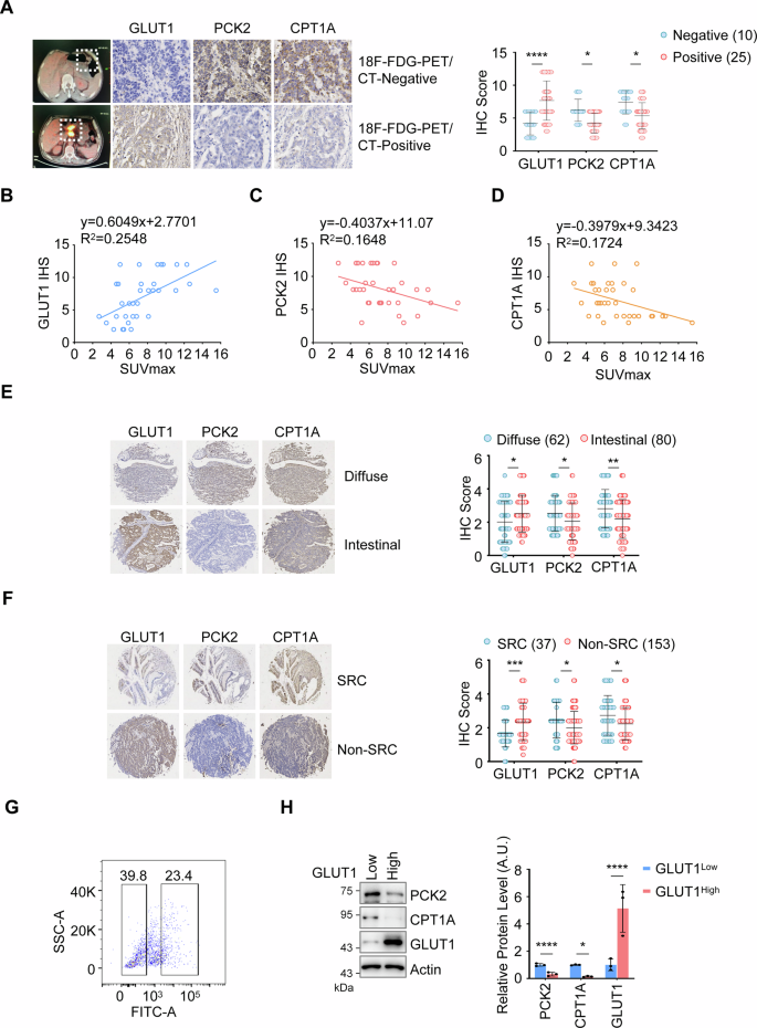 Fig. 4: PCK2 and CPT1A are enriched in and drive the progression of 18F-FDG-PET/CT-negative cancer.