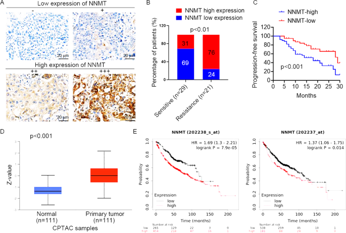 Fig. 2: NNMT expression is associated with the response to EGFR-TKIs treatment in NSCLC.