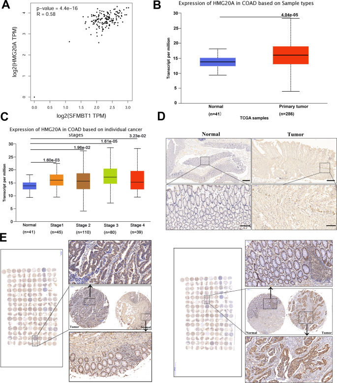 Fig. 4: HMG20A is increased in colorectal cancer (CRC) tissue.