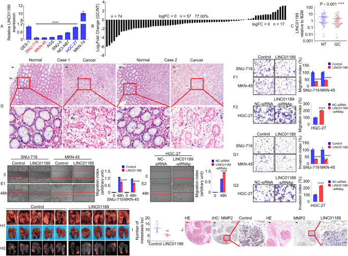 Fig. 3: LINC01189 is downregulated in GC tissues and associated with GC metastasis.
