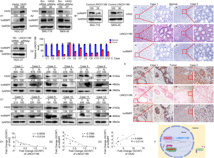 Fig. 7: Identification of a VAX2-LINC01189-hnRNPF axis in primary human GC samples.