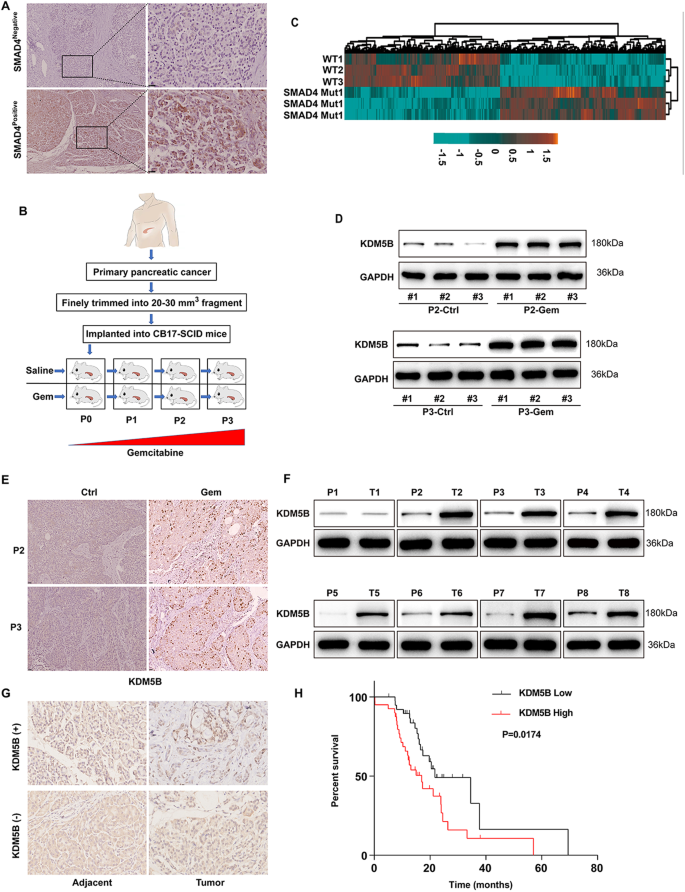 Fig. 1: KDM5B is overexpressed in PDAC with SMAD4 loss.