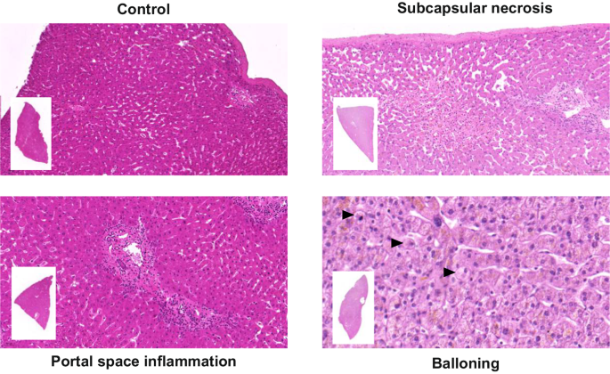 Fig. 1: Histological evaluation of donated livers.