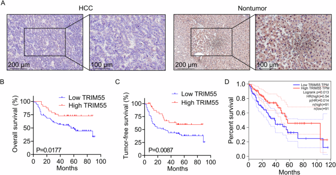 Fig. 1: Downregulation of TRIM55 predicts poor clinical outcome in patients with HCC.