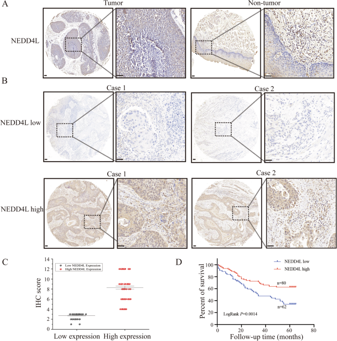 Fig. 1: NEDD4L expression is low and serves as a good prognosis marker in ESCC.