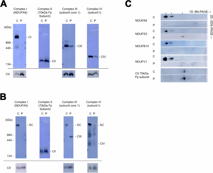 Fig. 2: Mitochondrial complex formation is disrupted in fibroblasts derived from the patient carrying the NDUFB7 mutations.