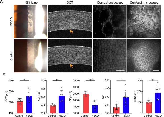 Fig. 1: Comparisons of corneal endothelial morphology in FECD and control patients.