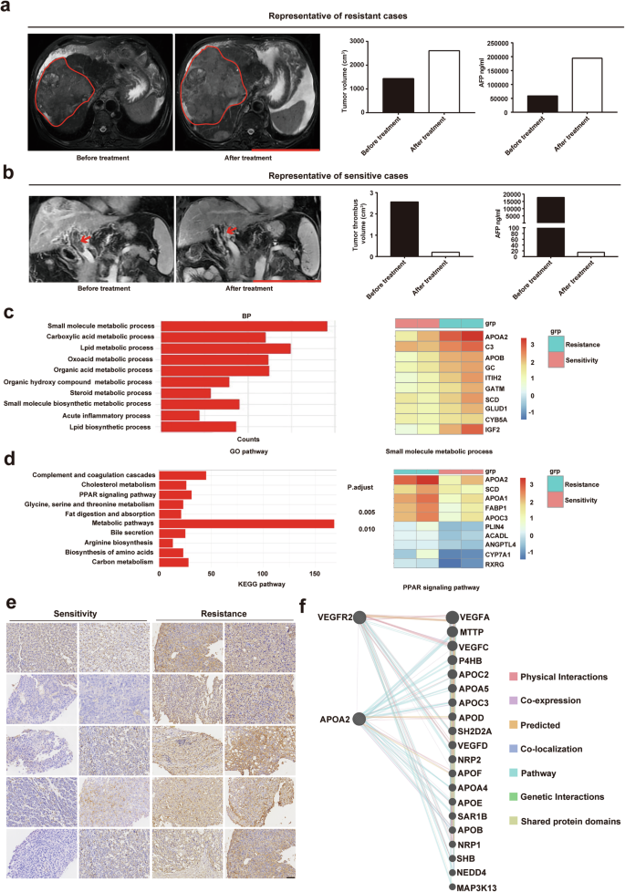 Fig. 1: High expression of APOA2 is highly correlated with resistance to AAD therapy in HCC.