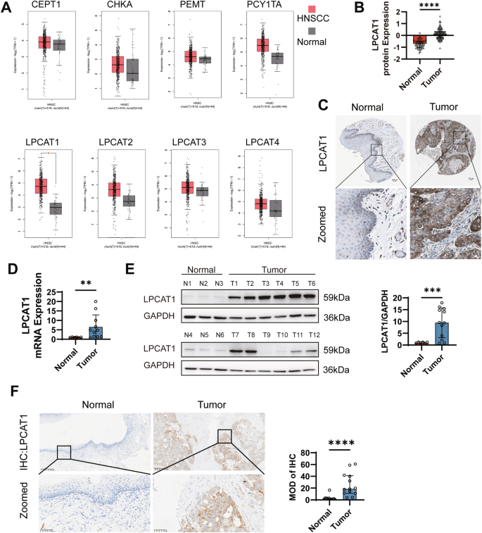Fig. 2: LPCAT1 expression was increased in HNSCC tissues.