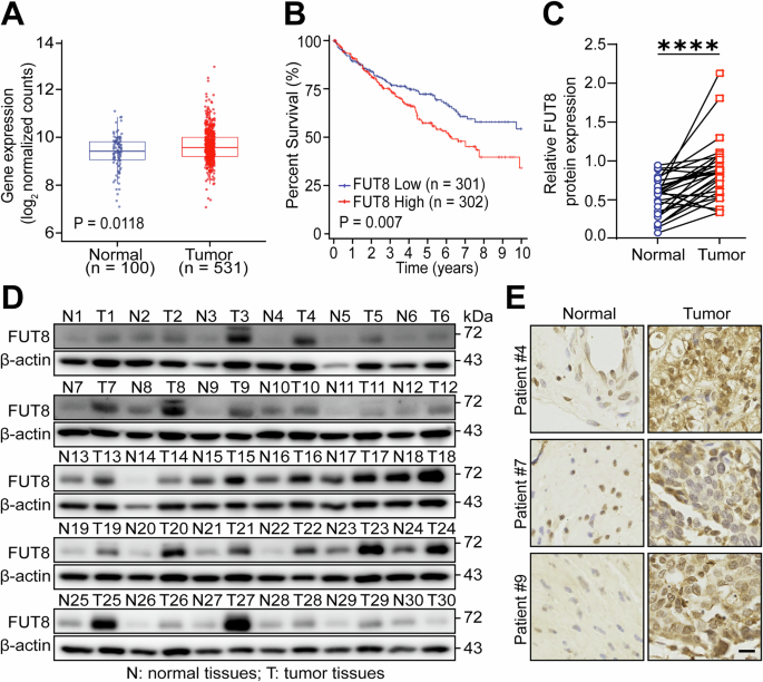 Fig. 1: FUT8 is highly expressed in ccRCC and associated with poor prognosis.