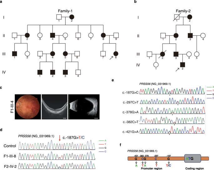 Fig. 1: Novel non-coding variants in the PRSS56 promoter were identified in two multigenerational HM families.