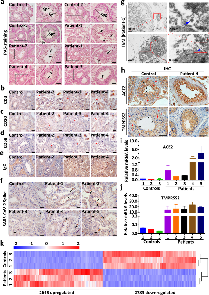 Pathological And Molecular Examinations Of Postmortem Testis Biopsies Reveal Sars Cov 2 Infection In The Testis And Spermatogenesis Damage In Covid 19 Patients Cellular Molecular Immunology