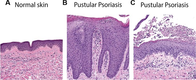 palmoplantar pustular psoriasis pathology